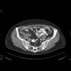Peritoneal carcinosis: CT - Computed tomography